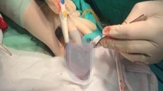 Cấp cứu nam thanh niên bị bò đá vỡ "của quý"