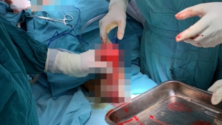 Nát nhừ 2 bàn tay vì vật liệu nổ