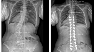 Trả lại 8cm chiều cao cho bệnh nhân sau ca mổ kéo dài hơn 7 giờ đồng hồ