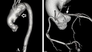 Cứu sống người đàn ông 50 tuổi bị phình động mạch chủ khổng lồ hiếm gặp