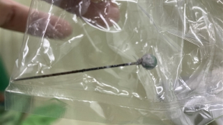 Phẫu thuật nội soi lấy cây kim gim ra khỏi bàng quang bệnh nhi