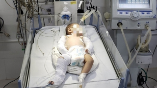 Bé gái 2 tháng tuổi gãy hai tay, chân, hôn mê sâu nghi bị bạo hành