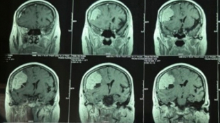 Phẫu thuật bóc khối u màng não to gần bằng quả lựu