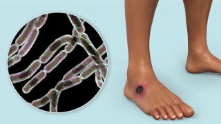 Điện Biên phát hiện 13 người mắc bệnh than, Bộ Y tế chỉ đạo khẩn