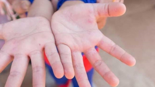 Gần 10 nghìn người mắc bệnh tay chân miệng, 3 ca tử vong