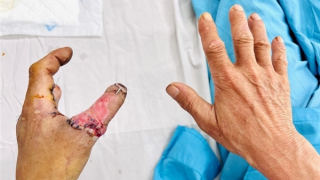 Nối thành công ngón tay bị đứt lìa do tai nạn lao động