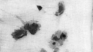 Nổ bình gas mini khiến bé gái bị vỡ sọ