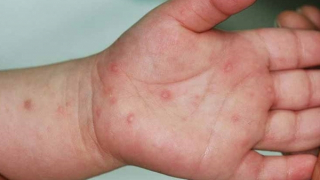 Bộ Y tế yêu cầu tăng cường theo dõi người bệnh tay chân miệng