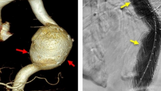 Cứu sống bệnh nhân người Campuchia bị vỡ túi phình khổng lồ động mạch chủ bụng