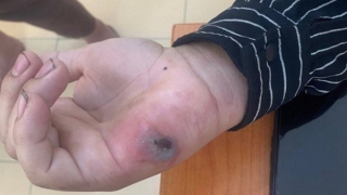 Bệnh than bùng phát ở một số tỉnh miền núi, đẩy mạnh biện pháp phòng, chống