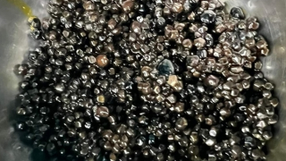 Cụ bà 73 tuổi có hàng nghìn viên sỏi mật