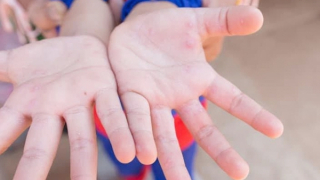 40% trẻ mắc bệnh tay chân miệng do chủng virus nguy hiểm