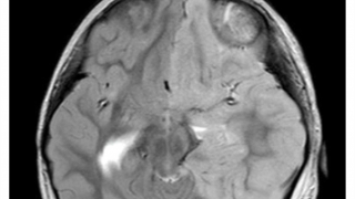 Cứu sống ngoạn mục 2 trẻ nguy kịch do bệnh não cấp hiếm gặp