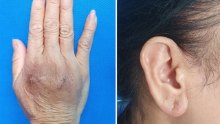 Biến chứng khó lường từ tiêm filler trôi nổi