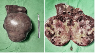 Phẫu thuật cắt bỏ khối u gan gần 2kg cho bệnh nhân