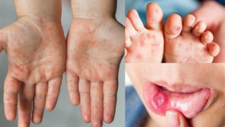 Đã có thuốc điều trị bệnh tay chân miệng nặng