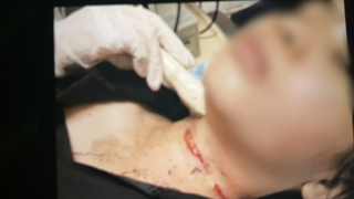 Tự cứa cổ mình rồi hoang báo bị cướp tấn công