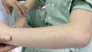 Lạm dụng thuốc xịt mũi, 2 anh em bị suy thượng thận