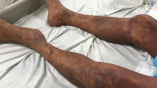 Thêm một bệnh nhân tử vong  do nhiễm liên cầu lợn