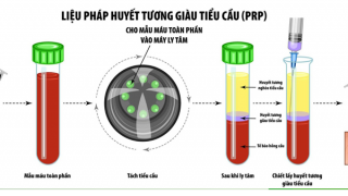 Bệnh viện 30-4 dùng huyết tương giàu tiểu cầu điều trị bệnh