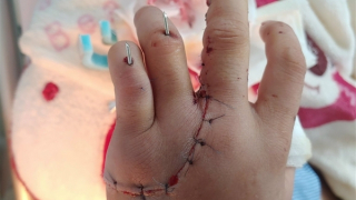 Ghép nối lại bàn tay cho nam bệnh nhân bị đứt lìa 2 ngón