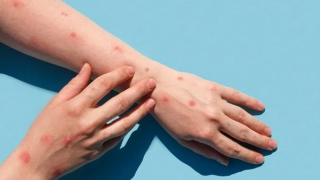 TP Hồ Chí Minh phát hiện 2 trường hợp mắc bệnh đậu mùa khỉ