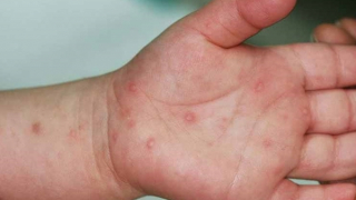 Đã có 21 ca tử vong vì tay chân miệng