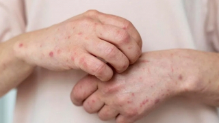 Đã có kết quả giải mã gene ca bệnh đậu mùa khỉ đầu tiên tại TP Hồ Chí Minh