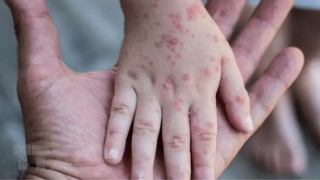 Dấu hiệu nào nhận biết bệnh đậu mùa khỉ?