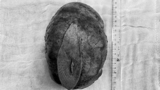 Cắt bỏ khối u kích thước 20cm cho cụ ông 97 tuổi