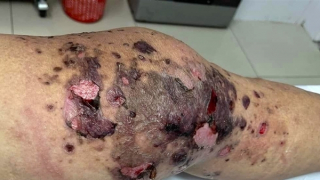 Đừng để tiền mất, tật mang vì nhờ thầy lang chữa bệnh bằng cách... đắp, bó lá