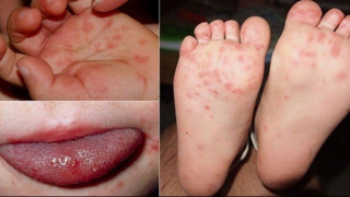 Cuối tháng 11 tiếp tục nhập 2.000 lọ thuốc điều trị tay chân miệng