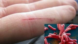 Nữ bệnh nhân tử vong do nhiễm “vi khuẩn ăn thịt người”