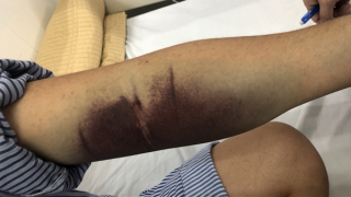 Nguy hiểm khi người tiểu đường mắc sốt xuất huyết