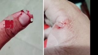 Người đàn ông phát bệnh dại tử vong sau hơn 1 tháng bị chó cắn