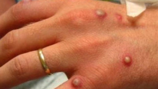 Việt Nam ghi nhận 56 ca mắc đậu mùa khỉ