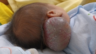 Cứu sống cháu bé 14 ngày tuổi có khối u máu khổng lồ