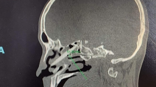 Phẫu thuật lấy đôi đũa đâm xuyên từ mũi vào não bệnh nhân