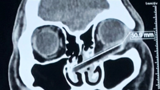 Bị kẻ ngáo đá dùng đũa đâm xuyên hốc mắt