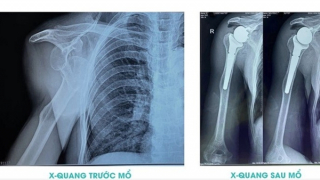 Lần đầu tiên Bệnh viện 199 thực hiện thành công phẫu thuật thay khớp vai toàn phần đảo ngược