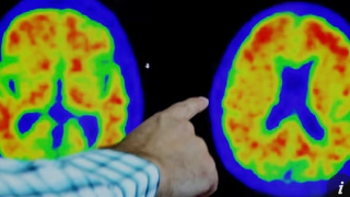 Thuốc mới mang đến hi vọng chữa bệnh Alzheimer từ năm 2024