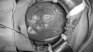 Cắt khối u gan khổng lồ hiếm gặp nặng 3 kg cho cô gái trẻ