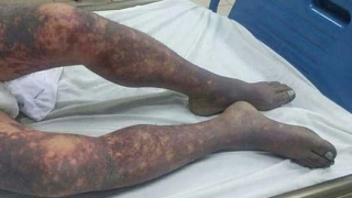 Người đàn ông tử vong sau khi ăn tiết canh lợn liên hoan tất niên