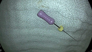 Trẻ 5 tuổi nuốt phải kim nha khoa có kích thước khoảng 2,5cm