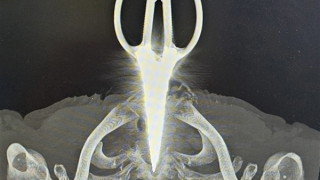 Cứu sống bệnh nhân cầm kéo tự đâm xuyên cổ