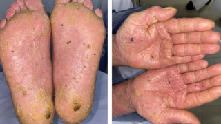 Uống thuốc đông y không rõ nguồn gốc, người đàn ông bị nhiễm độc asen nặng