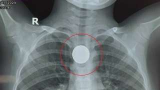 Cứu sống bé trai 6 tuổi nuốt đồng xu vào thực quản