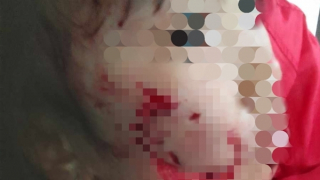 Bé gái 5 tuổi bị chó dữ cắn trọng thương vùng mặt