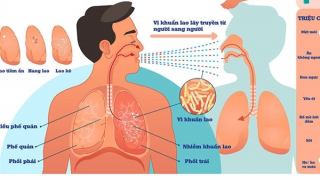 Khoảng 13 nghìn người tử vong vì bệnh lao mỗi năm, Thủ tướng chỉ đạo tăng cường phòng, chống
