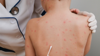 Bé trai 12 tuổi suýt tử vong khi mắc thuỷ đậu